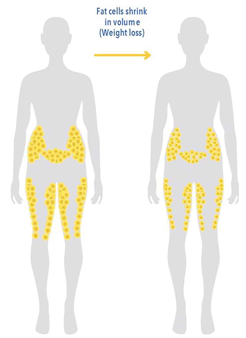 Coolsculpting Treatment Aesthetic Clinic KL Selangor Malaysia