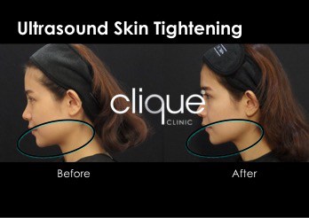 ultrasound skin tightening
