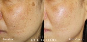 Enlighten PICO Genesis™ Laser Malaysia - Clique® Clinic Malaysia