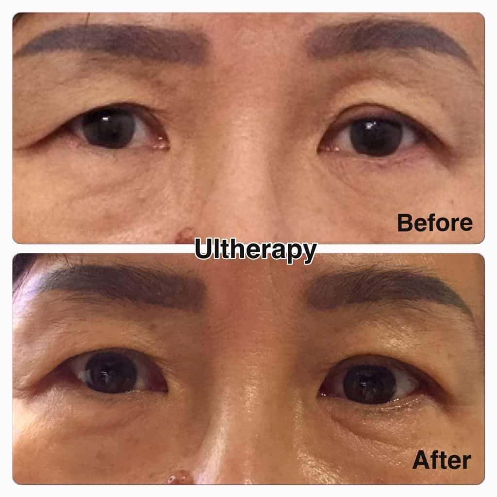 Tissue & Collagen Regeneration - IMG 3300 3