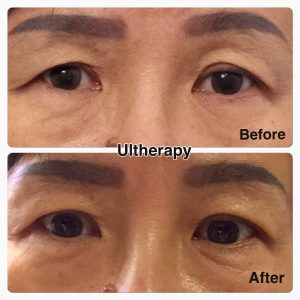 Ultherapy Malaysia | Non-Invasive Facelift - Clique®Clinic