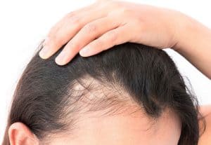 Read more about the article Hair Transplant in Malaysia: All You Need to Know