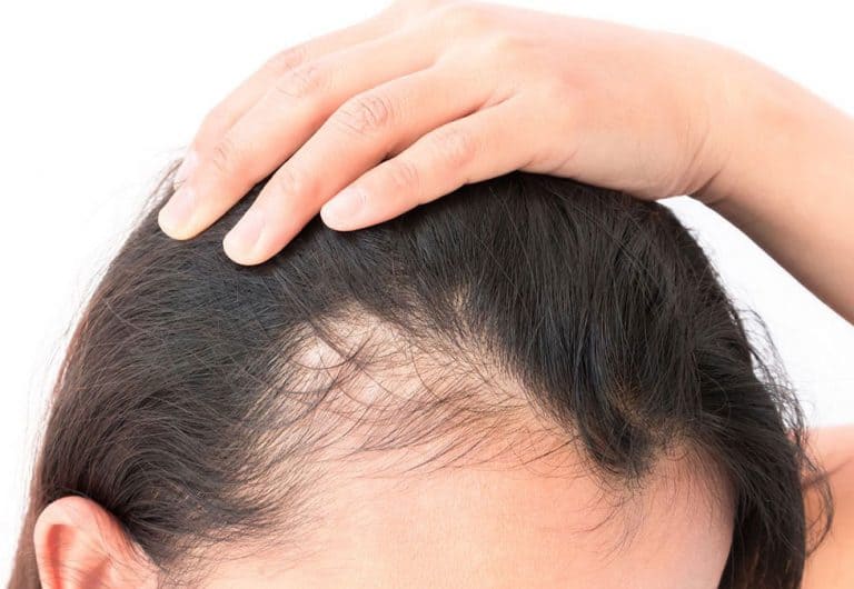 Hair Fall & Loss Treatment Malaysia - Clique® Clinic Malaysia