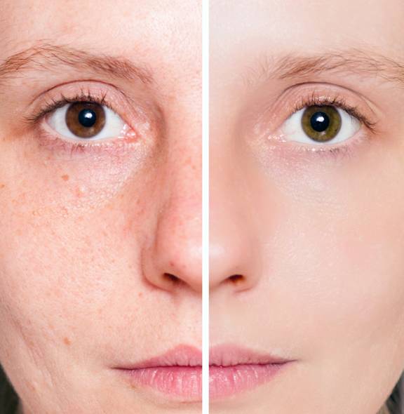 Face Slimming - Q Switched Laser 3 Hyperpigmentation Treatment - Clique® Clinic