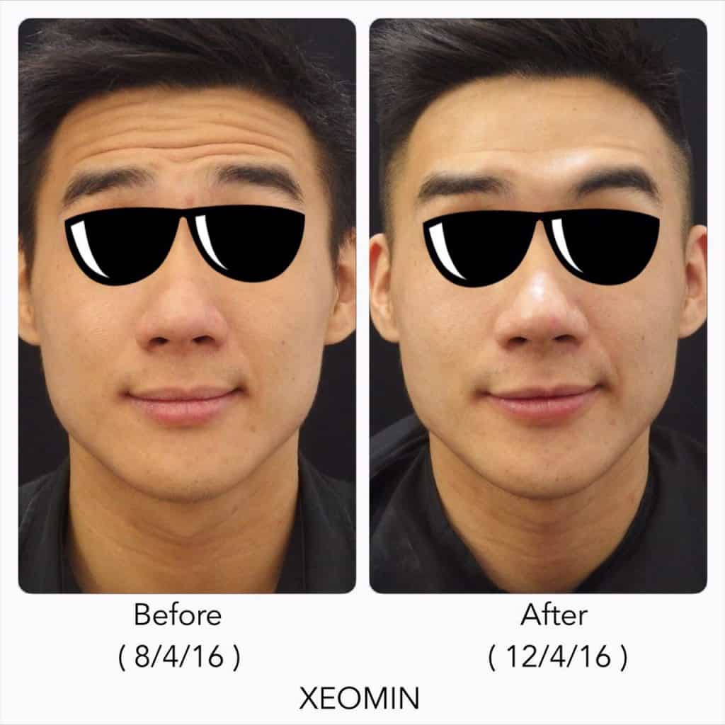 Fine Lines Under Eyes - Xeomin Wrinkle Treatment 2 Fine Lines Under Eyes Treatment Xeomin®Clique® Clinic- Clique® Clinic