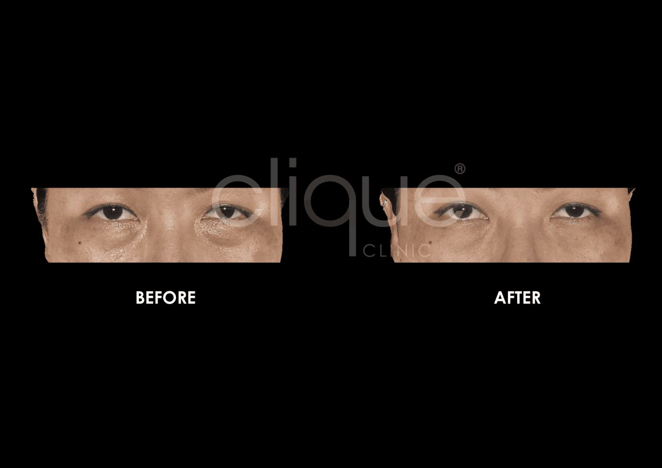 Sylfirm™ | Bi-Polar RF Microneedling - Clique® Clinic Malaysia