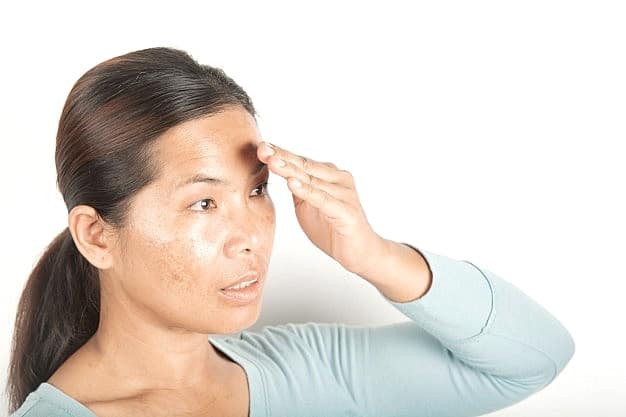 Read more about the article What Is The Best Way To Treat Melasma?