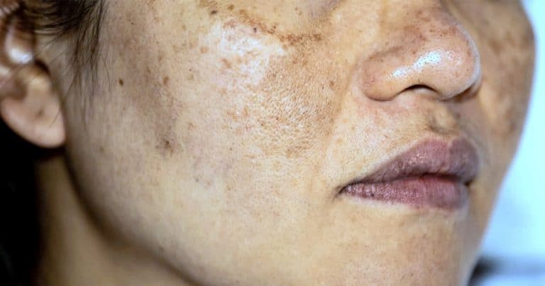 Read more about the article How Can I Reduce Melasma On My Face?