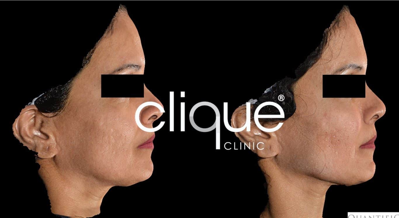 Dermal Fillers - BGI Ultherapy 7 ultherapy_hafiller_cliqueclinic