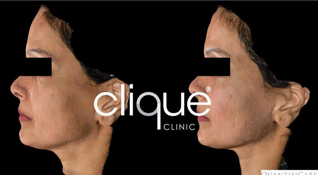 Belotero® - BGI filler 1 2 Belotero® - BGI filler 1 1