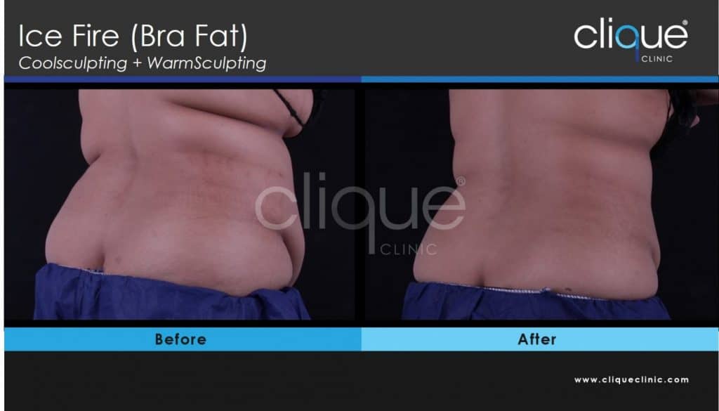 coolsculpting back