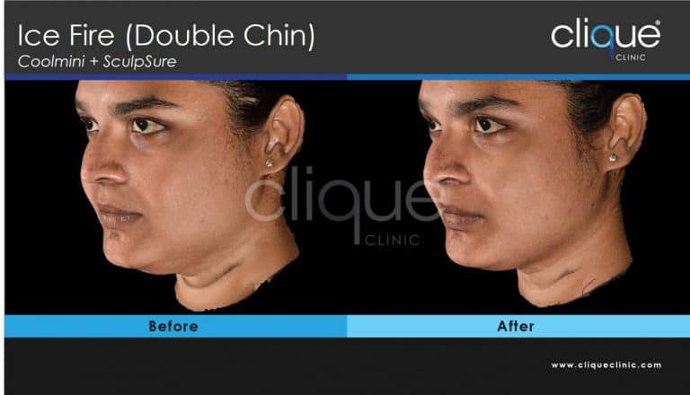 Double Chin - Ice Fire Chin KS 2 coolsculpting_sculpsure_cliqueclinic