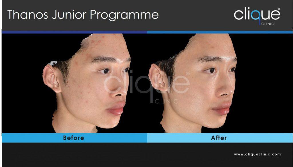 Sylfirm_Scars_CliqueClinic