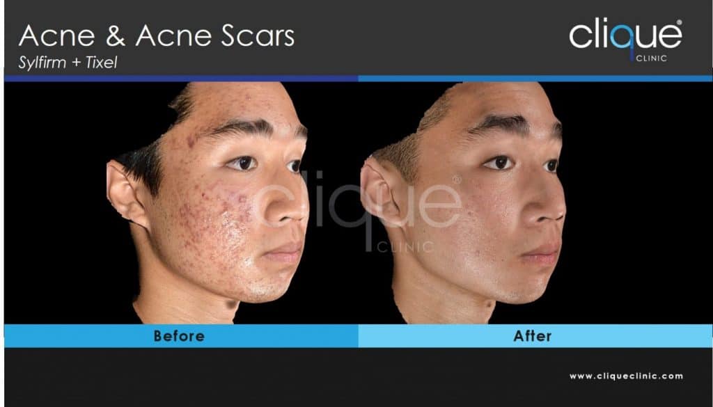 CliqueClinic_Sylfirm_Acne