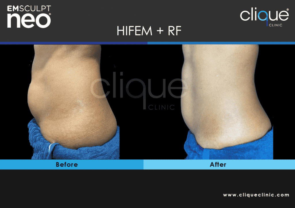 EMSculpt Neo Malaysia - NEO female abs 1 EMSculpt Neo Malaysia - NEO female abs 1