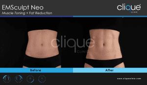 EMSsculptNEO_CliqueClinic_result