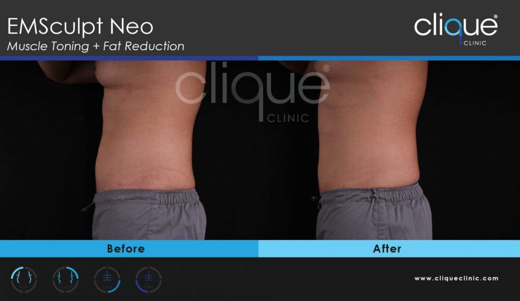 CliqueClinic_EMSculptNEO_