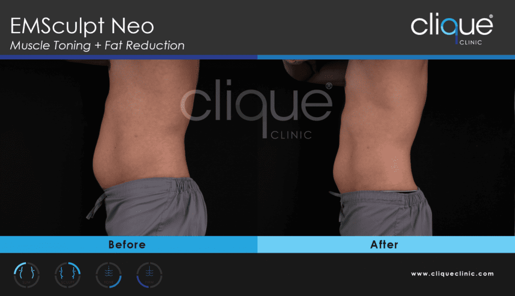 EMSculpt Neo Before and After Photos - NEO LL 1