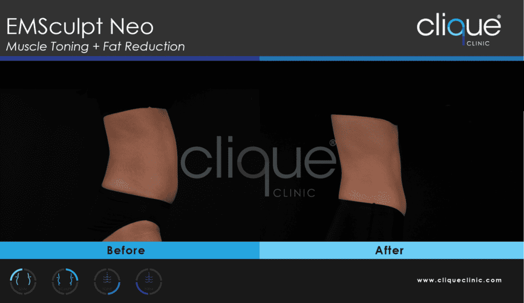 EMSculpt Neo Before and After Photos - NEO WD 3