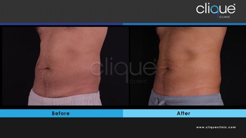 EMSculpt Neo Before and After Photos - WhatsApp Image 2021 02 26 at 2.01.13 PM 2