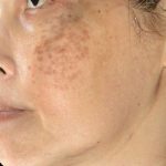 Hyperpigmentation - Abnom 1 6 Hyperpigmentation - Abnom 1 2