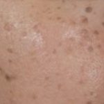Hyperpigmentation - Seborrheic keratosis 418x349 1 4 Hyperpigmentation - Seborrheic keratosis 418x349 1 1