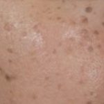 Hyperpigmentation - Seborrheic keratosis 418x349 1 1