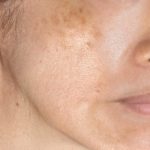 Hyperpigmentation - early 2 1 早期黄褐斑 (肝斑) 黑斑