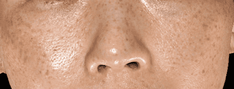 雀斑 Freckles 雀斑 Freckles
