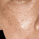 Hyperpigmentation - freckles 4 5 Freckles