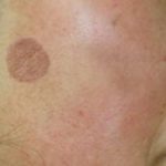 Hyperpigmentation - 3 Lentigo Age Spot