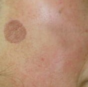 Age Spot - 1 Lentigo Age Spot