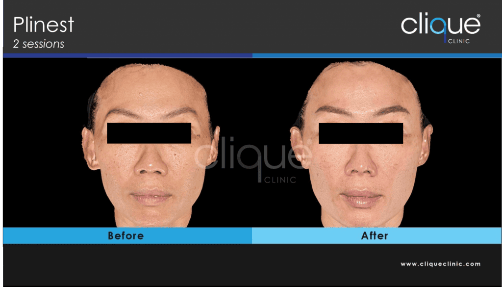 Plinest result clique clinic