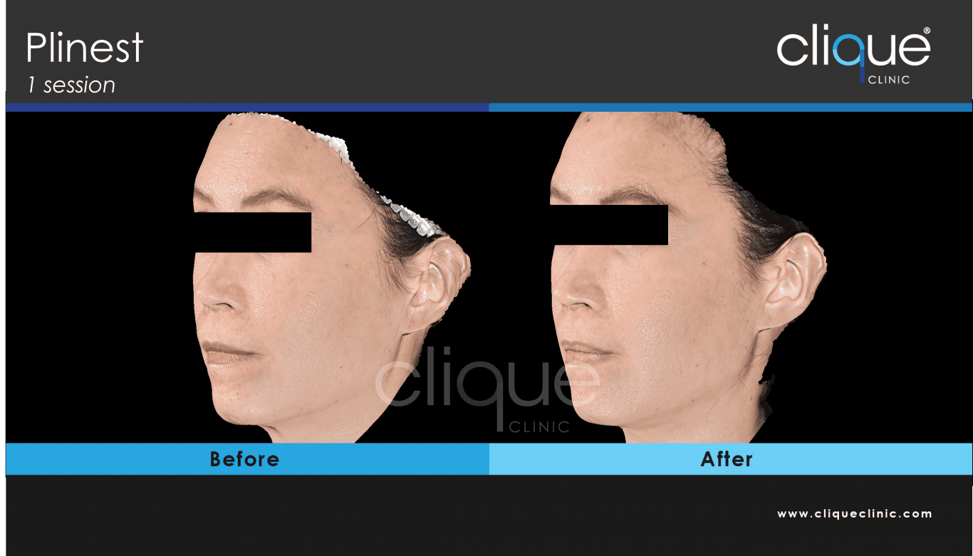 You are currently viewing PLINEST Before and After