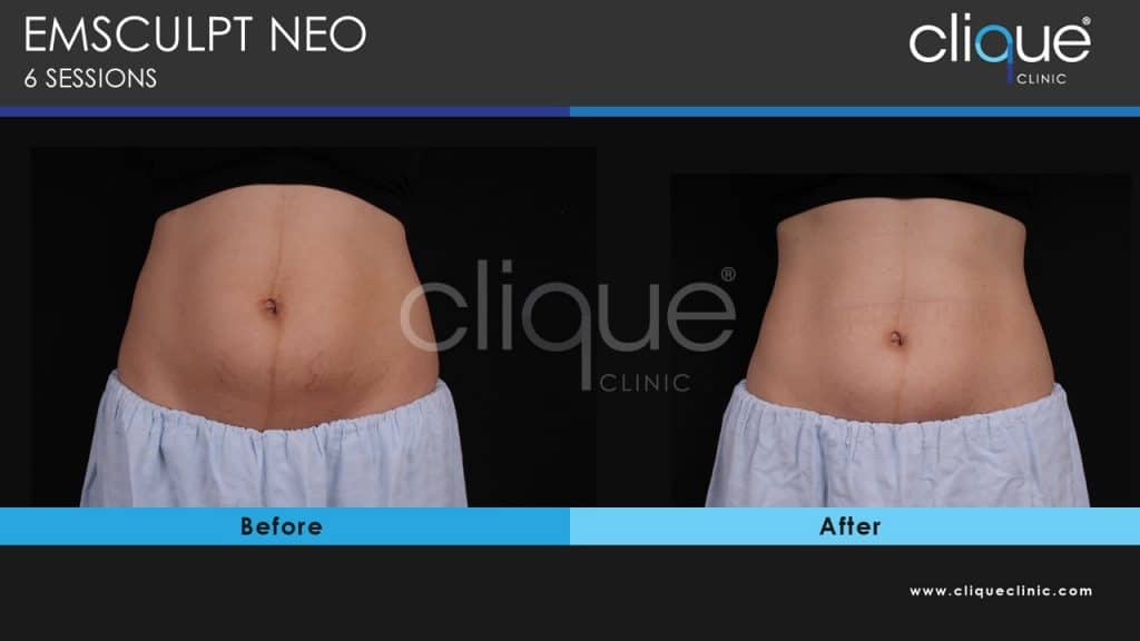 EMSculpt Neo Diastasis Recti