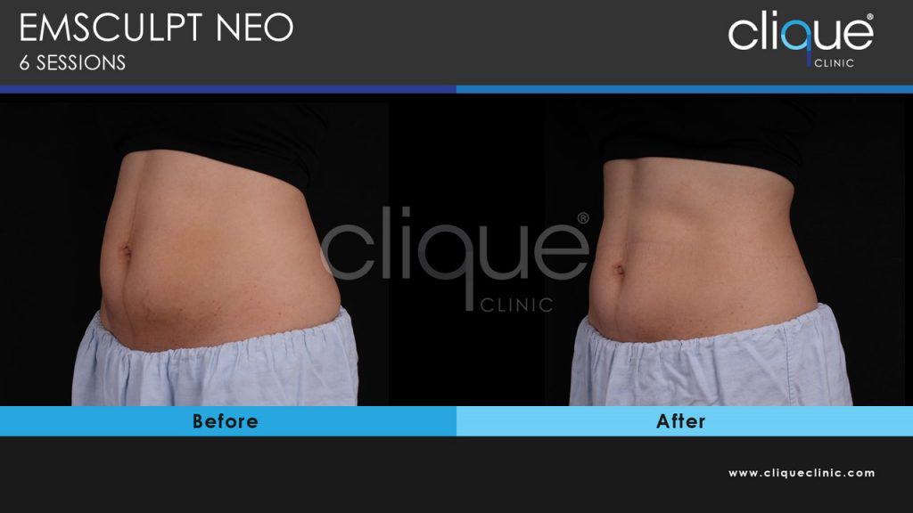 EMSculpt Neo Abdominal Separation