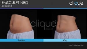 EMSculpt Neo Abdominal Separation
