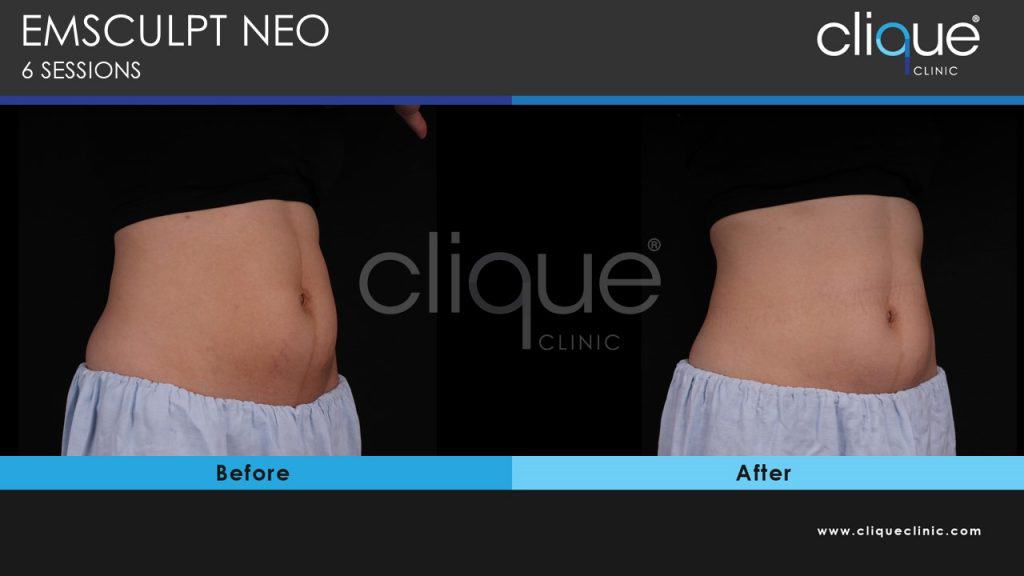 EMSculpt Neo Muscle Separation