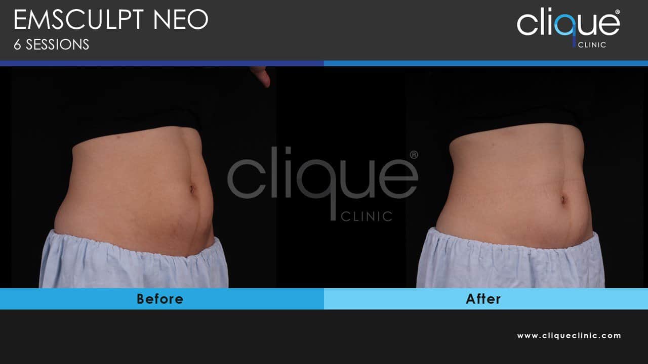 EMSculpt Neo vs Cooltone: Which One Is The Best For You? - Slide5 2 EMSculpt Neo Muscle Separation