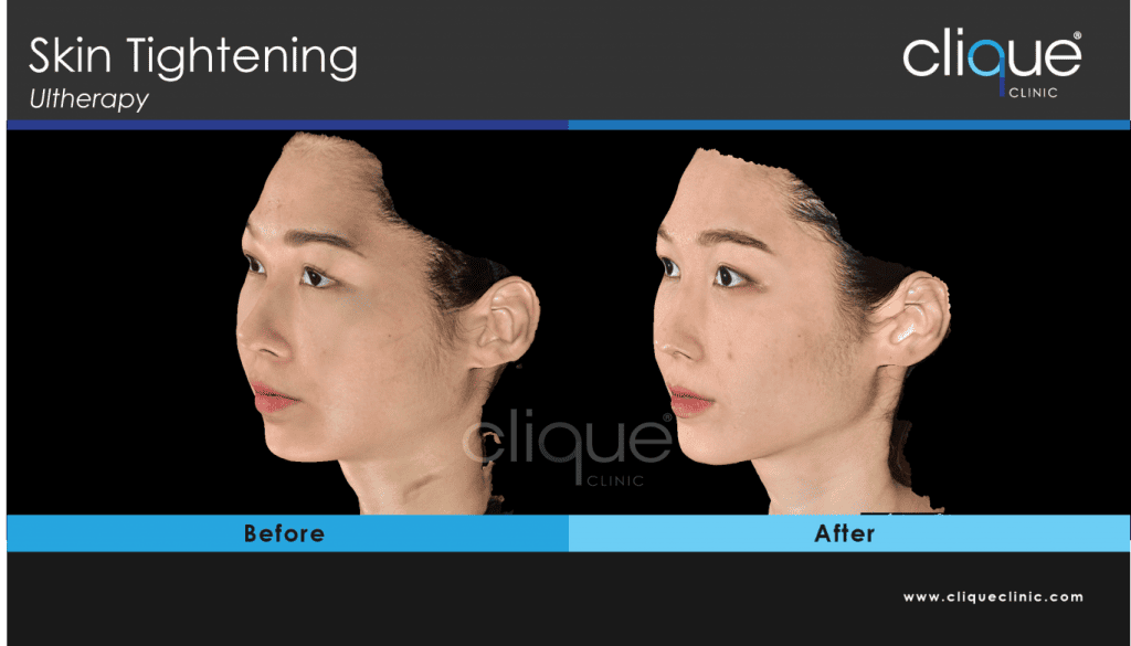 Ultherapy_before_and_after
