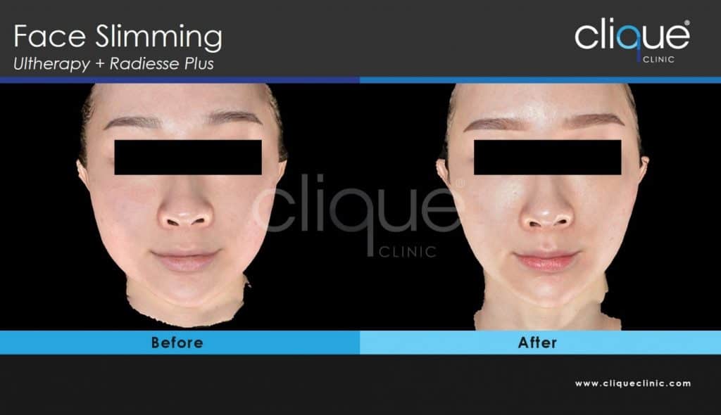 Ultherapy before and after