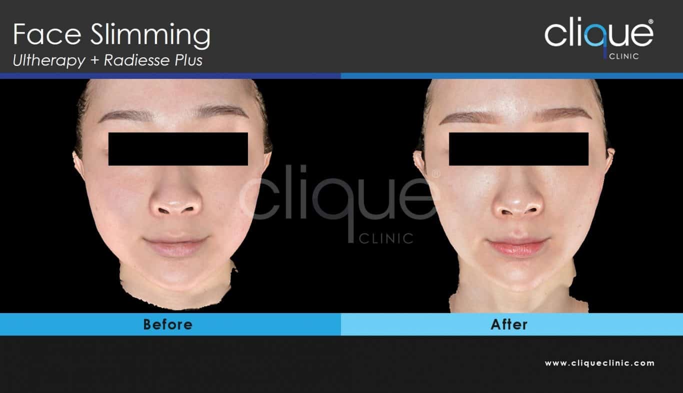 Ultherapy before and after