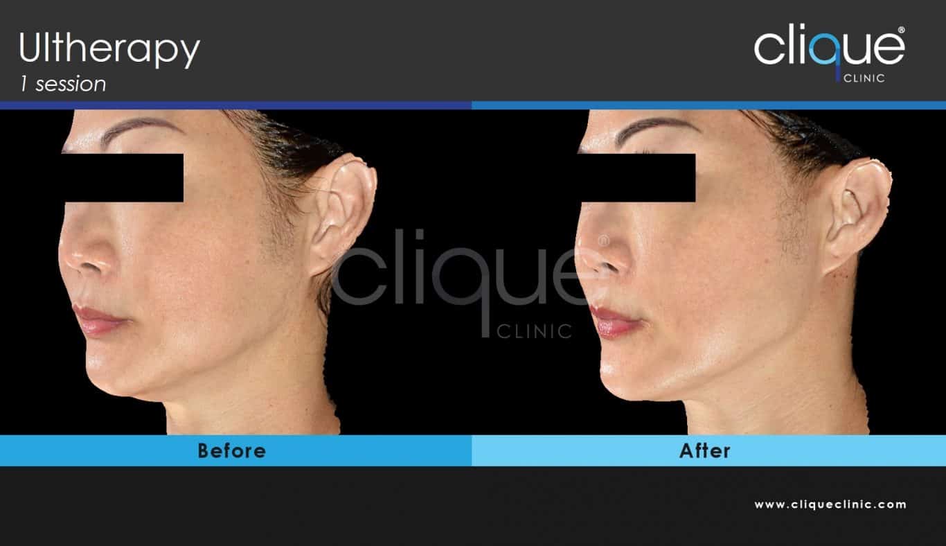 Ultherapy before and after