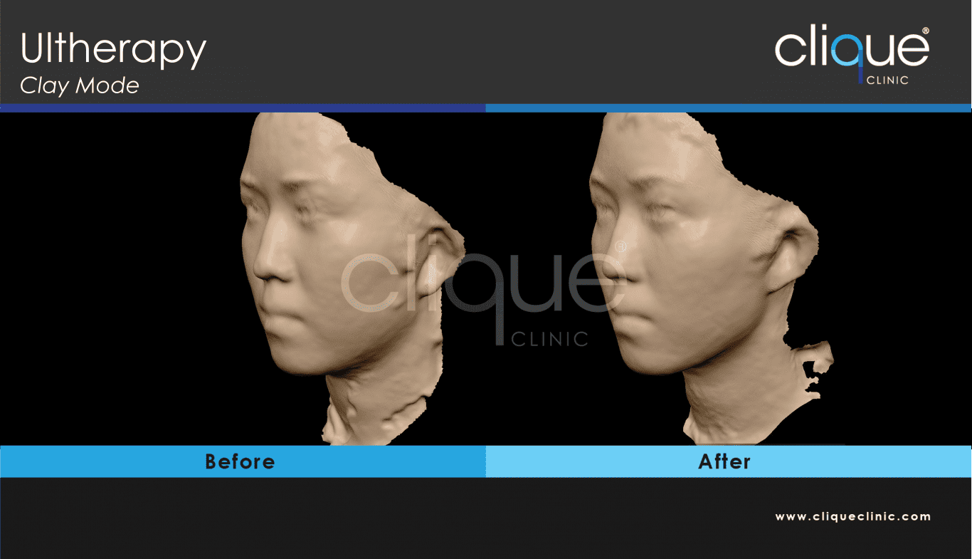 Ultherapy result