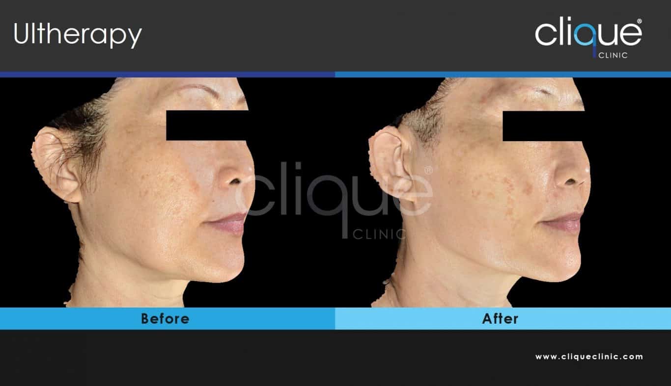Ultherapy before and after