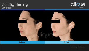 Read more about the article Ultherapy Before and After