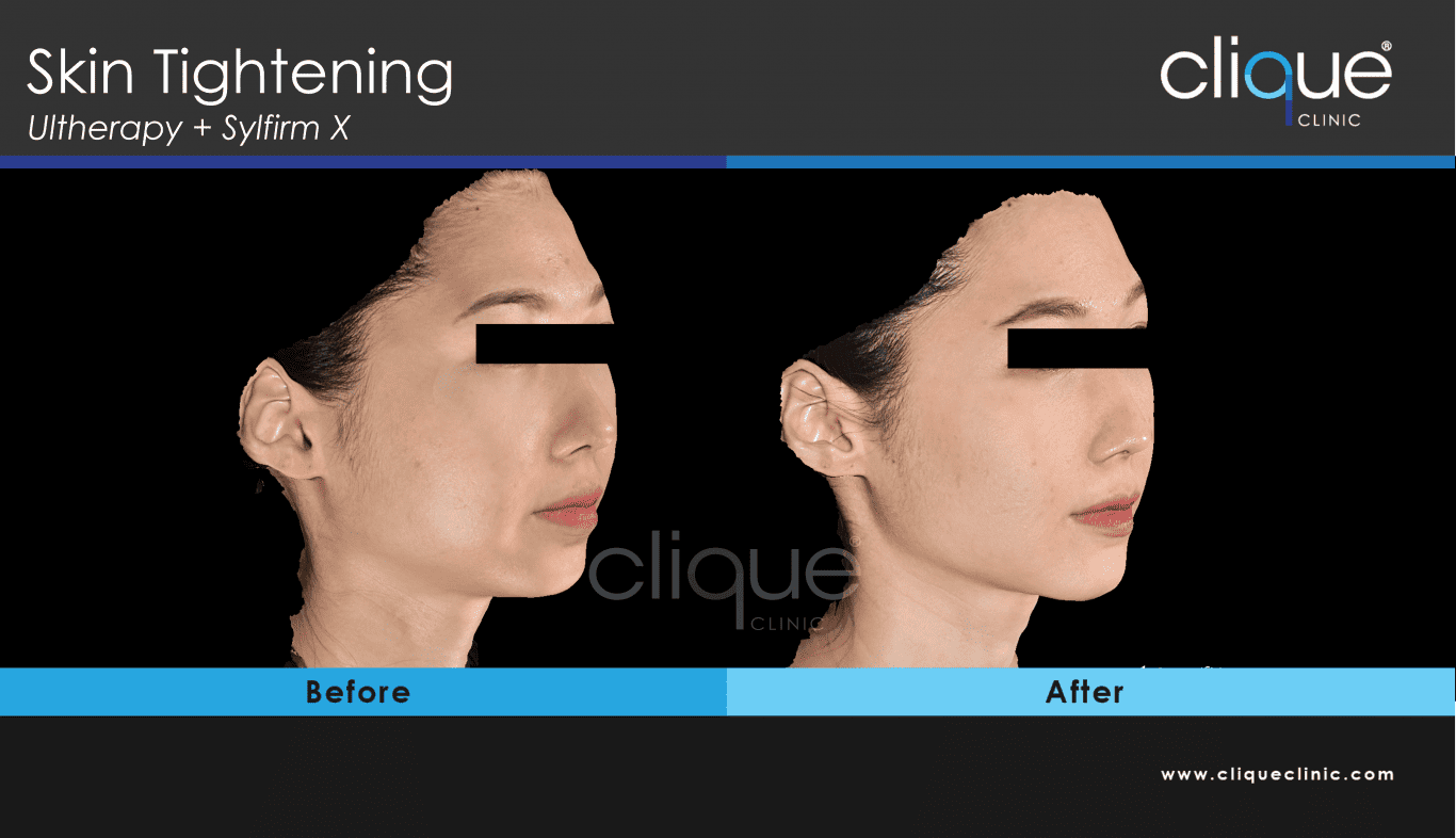 Ultherapy & Sylfirm X result