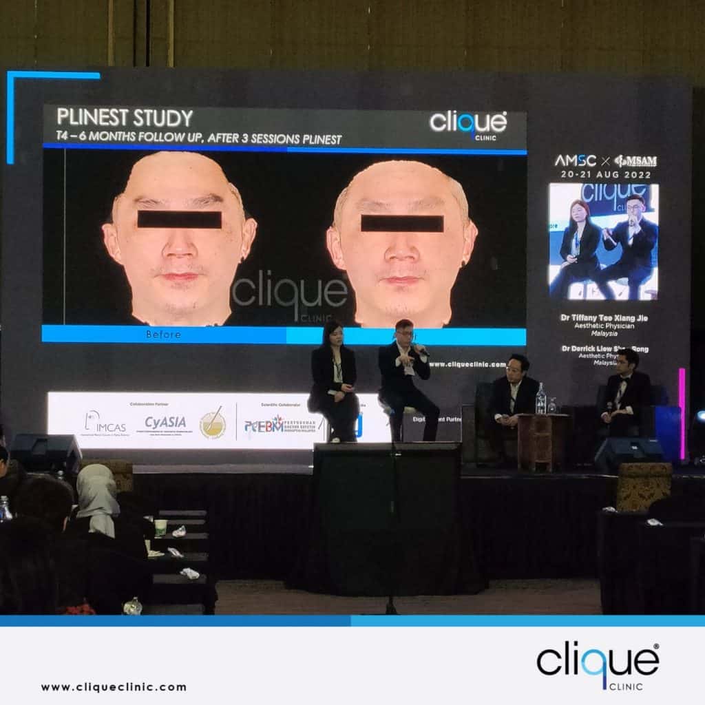 Rejuran vs Plinest 谁才是最强Skin Booster？