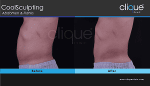 CoolSculpting Before After Photos
