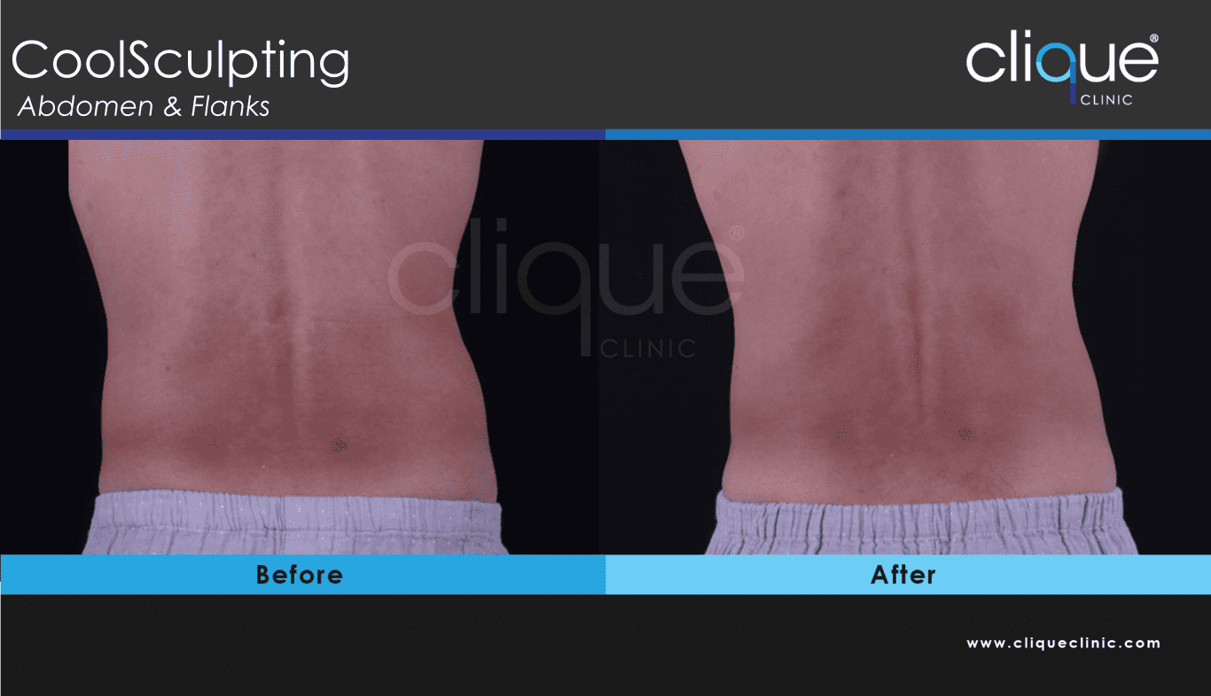 CoolSculpting Before After Photos - Clique Clinic
